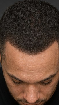 SMP hairline-look result