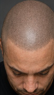 What Is Scalp Micropigmentation (SMP)?