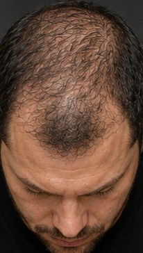 Before SMP, diffuse thinning