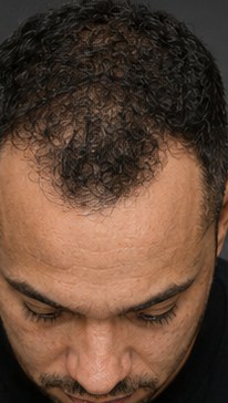 Before SMP, receded hairline