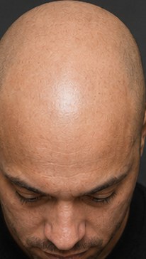 Before SMP, significant hair loss